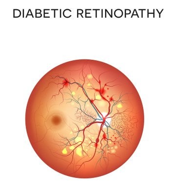 Diabetic Retinopathy