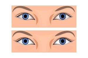 Eye Infections