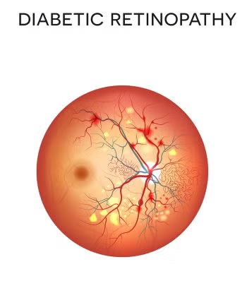 Diabetic retinopathy