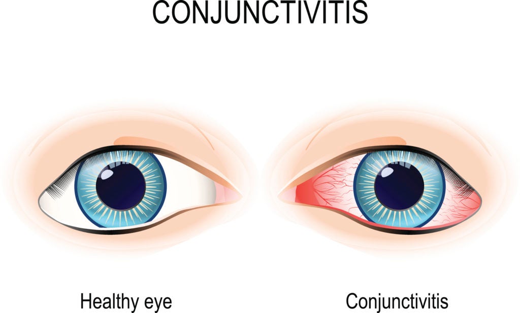 Conjunctivitis