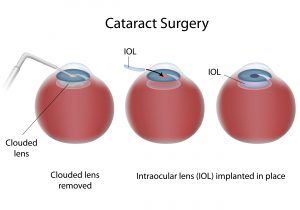 Cataract Surgery Procedure by Spindel Eye Associates