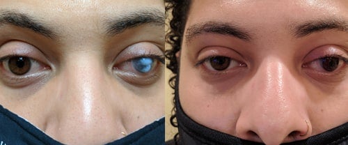 Glaucoma Surgery In Southern NH Glaucoma Surgery In Southern NH