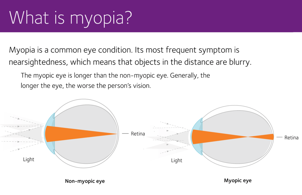 Myopia Management Program In Southern NH