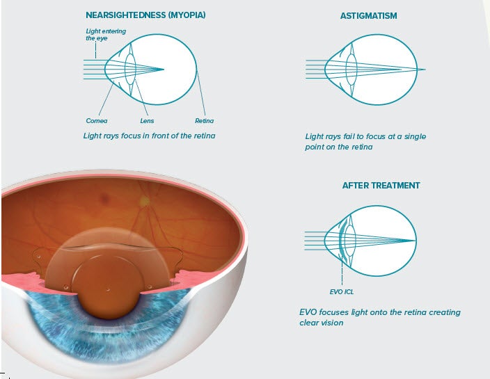 EVO ICL Eye Surgery in Derry & Surrounding Areas