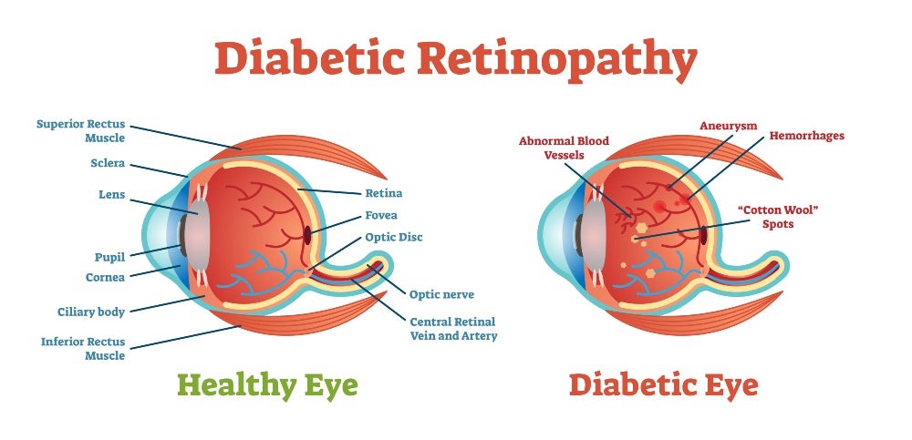 Diabetic Retinopathy in Derry, Windham, & Londonderry, NH