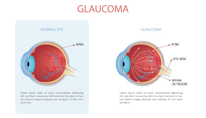 Glaucoma Surgery in Derry, NH & Surrounding Areas