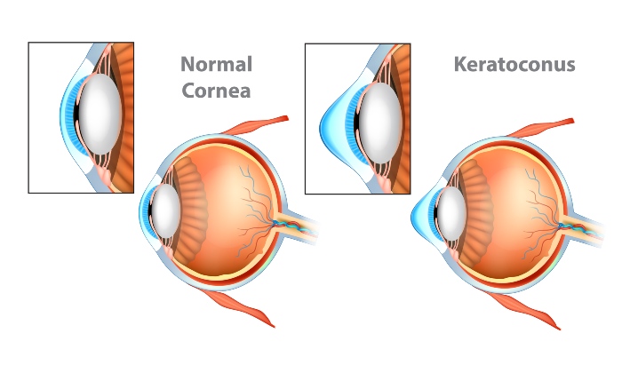Corneal Cross-Linking in Derry, NH & Surrounding Areas