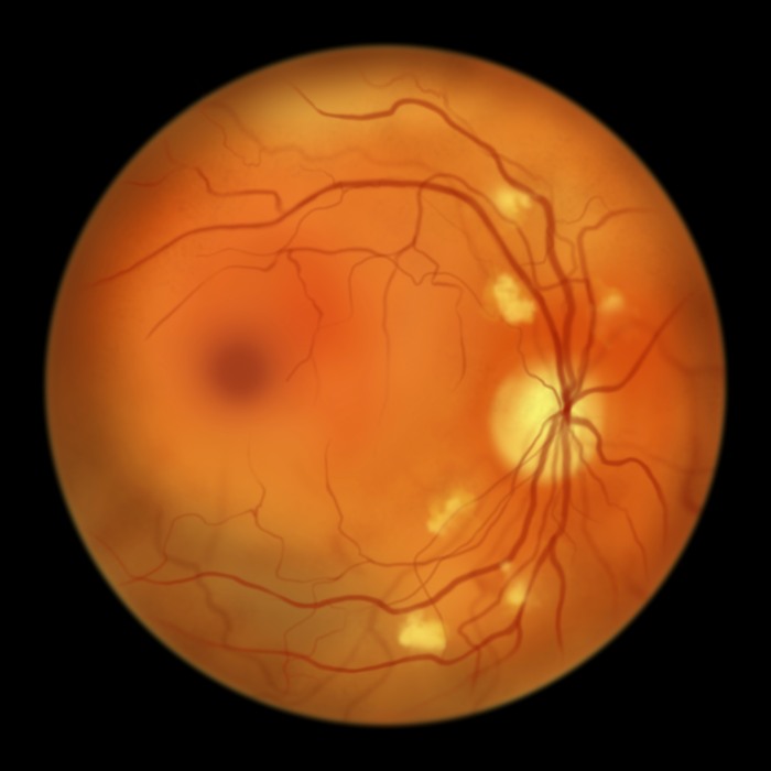 Diabetic Retinopathy Treatment in Derry & Surrounding Areas
