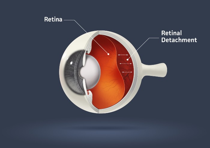 Retinal Detachment Treatment in Derry, NH & Nearby Areas