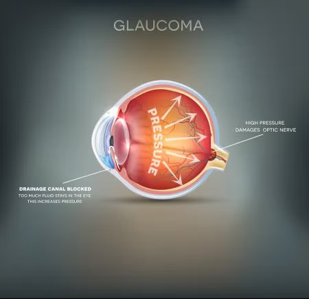 Glaucoma