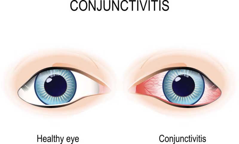 conjunctivitus