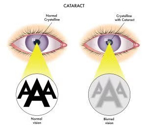 Diagram comparing eyes with and without cataracts.