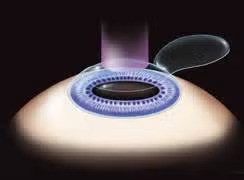 lasik surgery illustration
