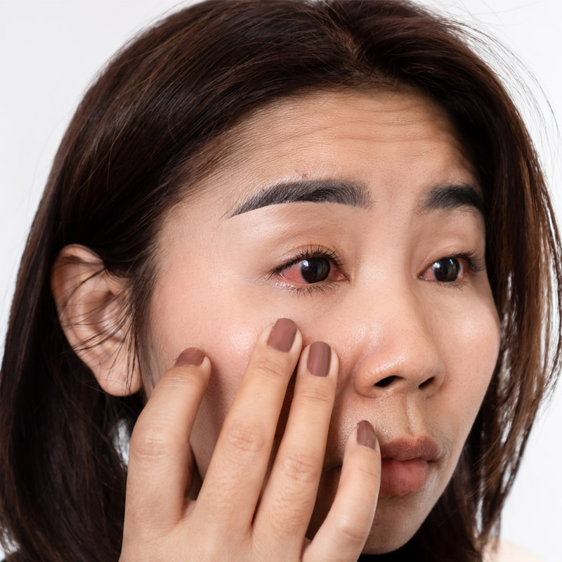 woman with bloodshot eye