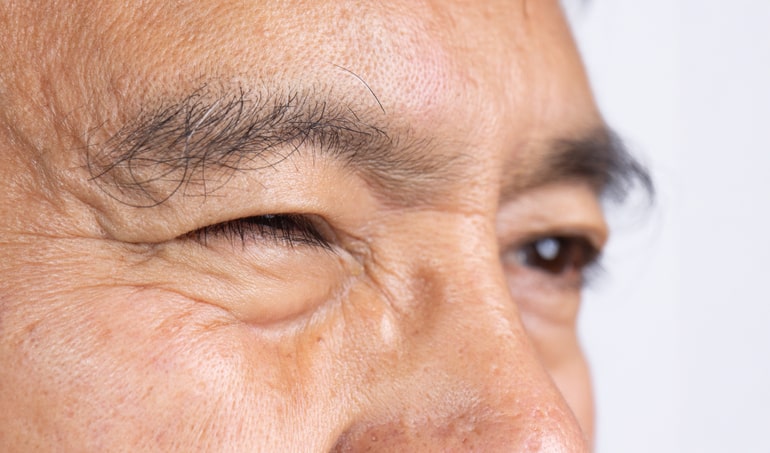 Close-up of eye area showing eyelid spasms in Derry, NH, and the surrounding areas