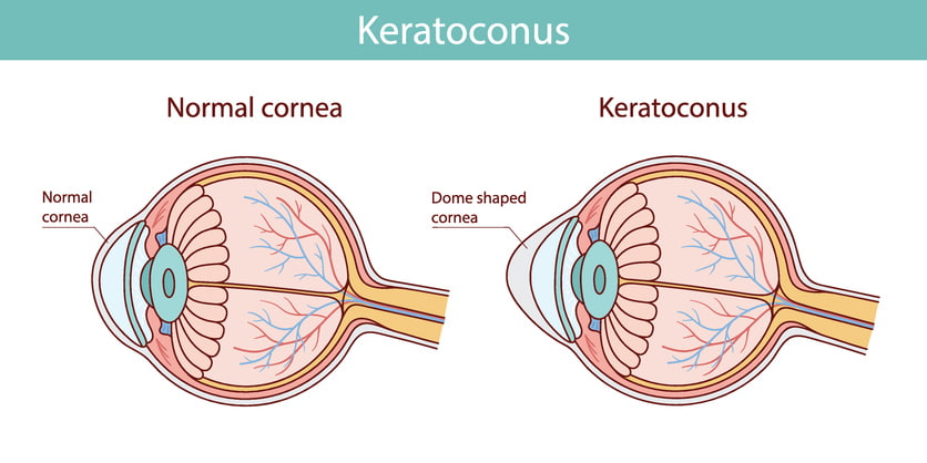 Medical illustration comparing a normal cornea with a cornea affected by keratoconus in Southern NH