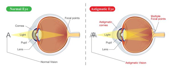 Astigmatism Treatments in Derry NH