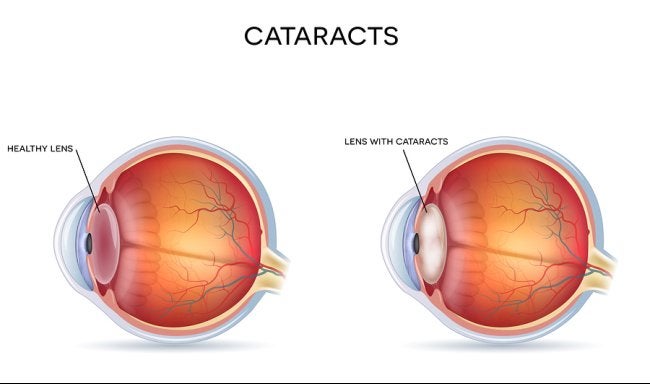 Cataract Treatments in Derry & Surrounding Areas