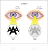 How to spot cataract?